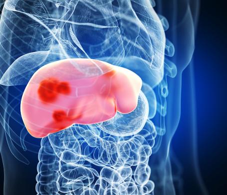 Liver Cancer
